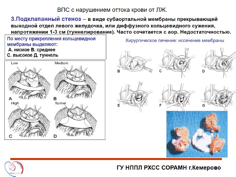 ГУ НППЛ РХСС СОРАМН г.Кемерово ВПС с нарушением оттока крови от ЛЖ. 3.Подклапанный стеноз